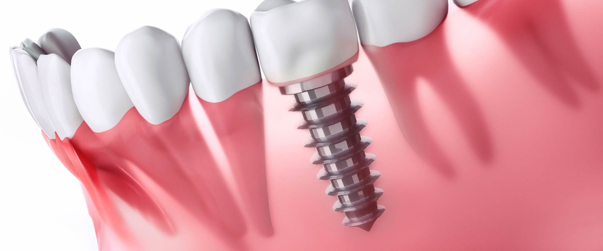 Can dental implants cause health issues?