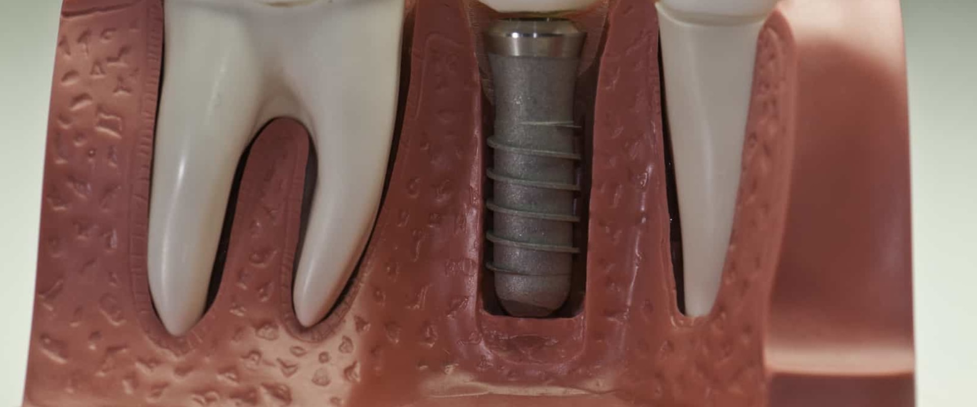 Are dental implants permanent?