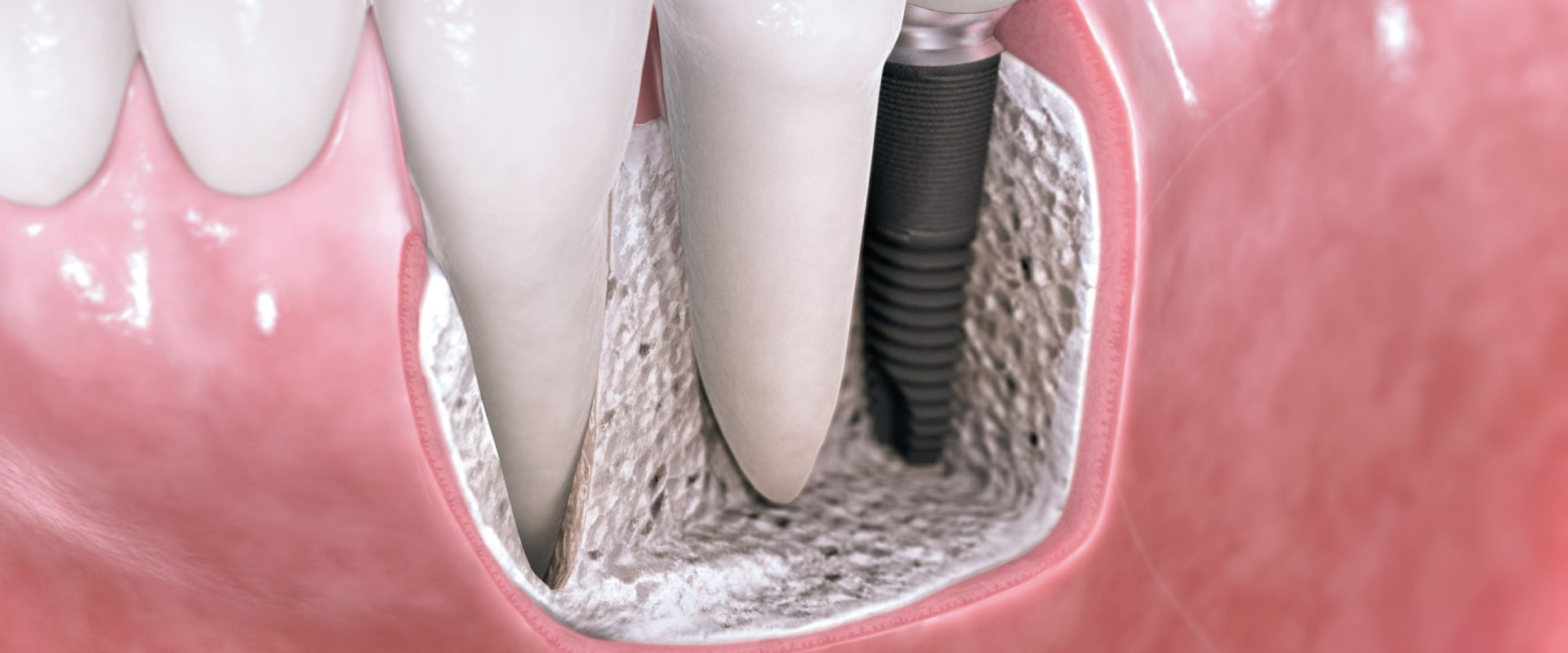 Are dental implants covered by insurance?