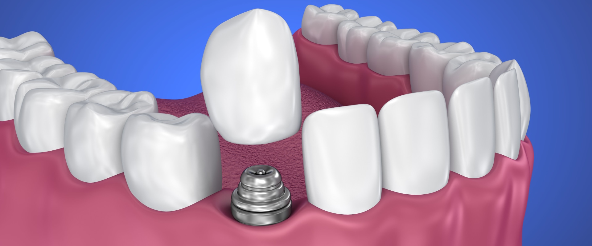 What is the most common cause of implant failure?