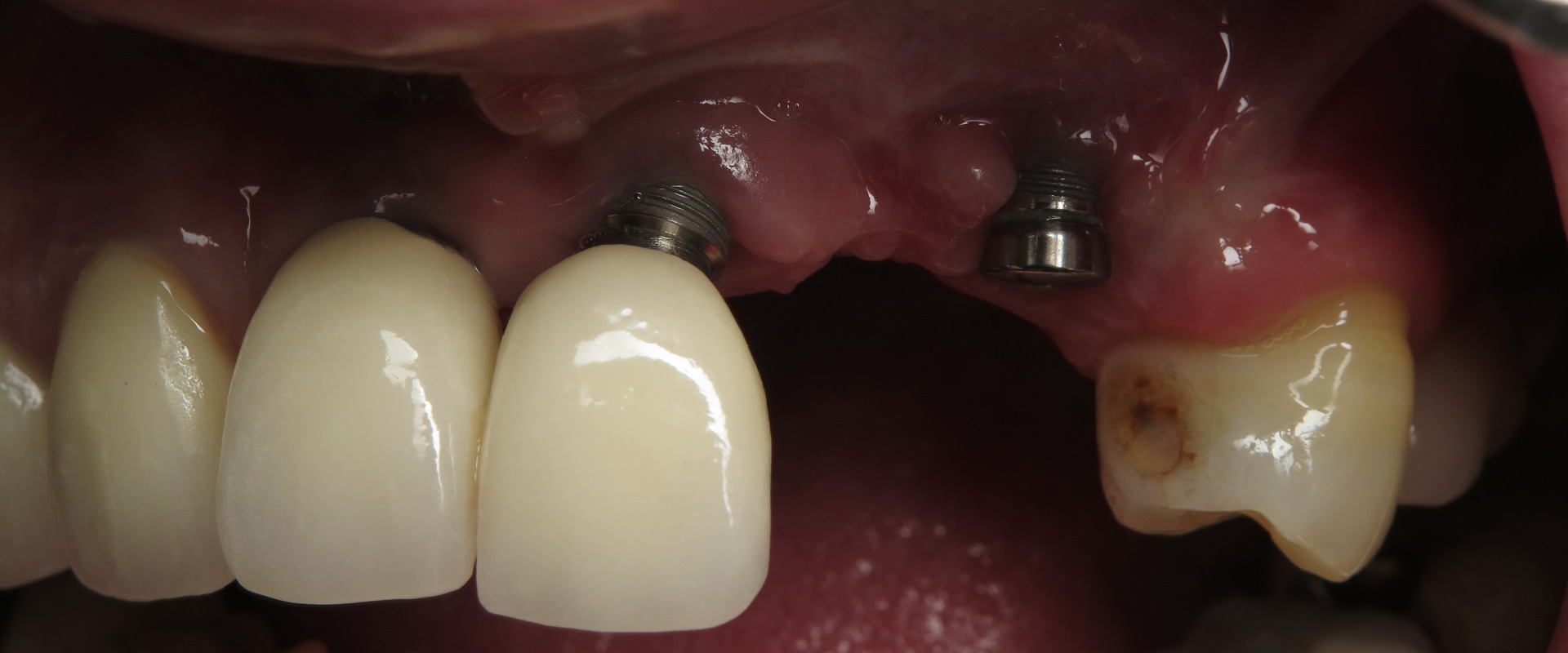 Can dental implants fall out?