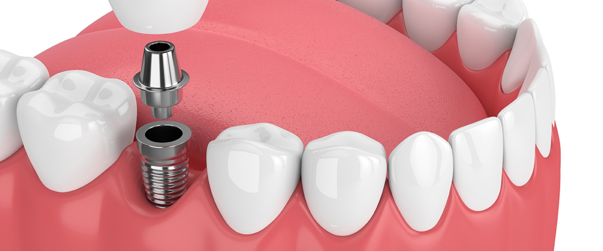 Modern Dental Implants Explained By A Professional Dentist In Taylor, Texas