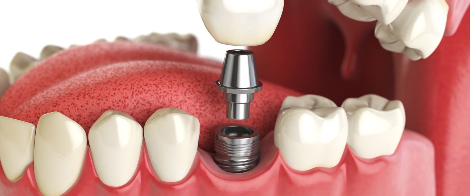 Which dentist do implants?
