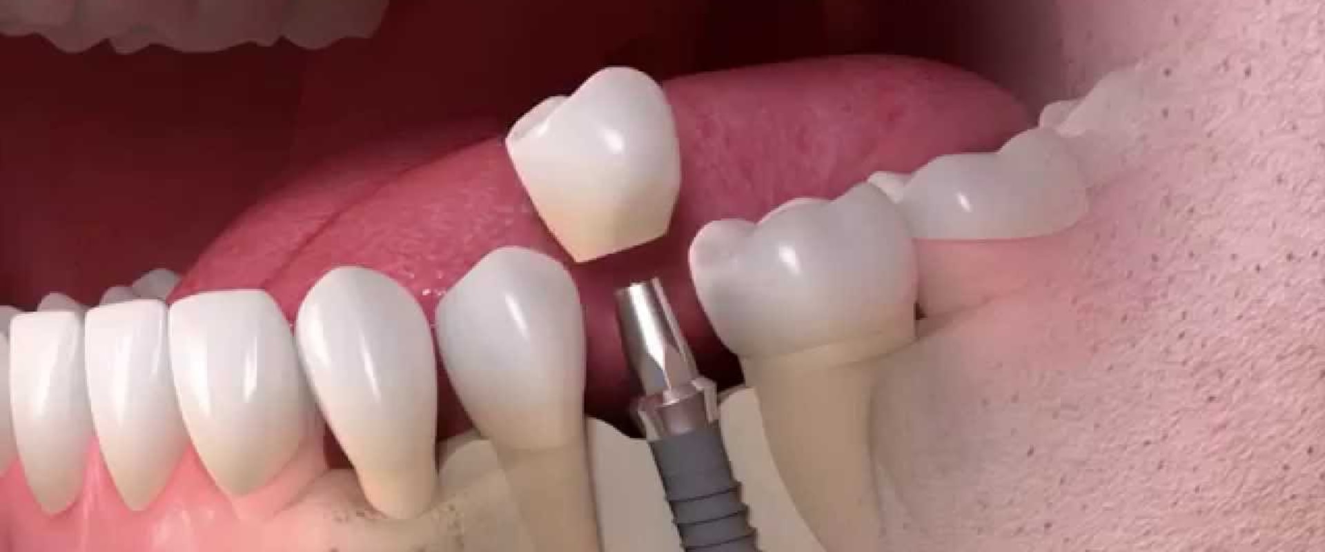 Where are dental implants the cheapest?