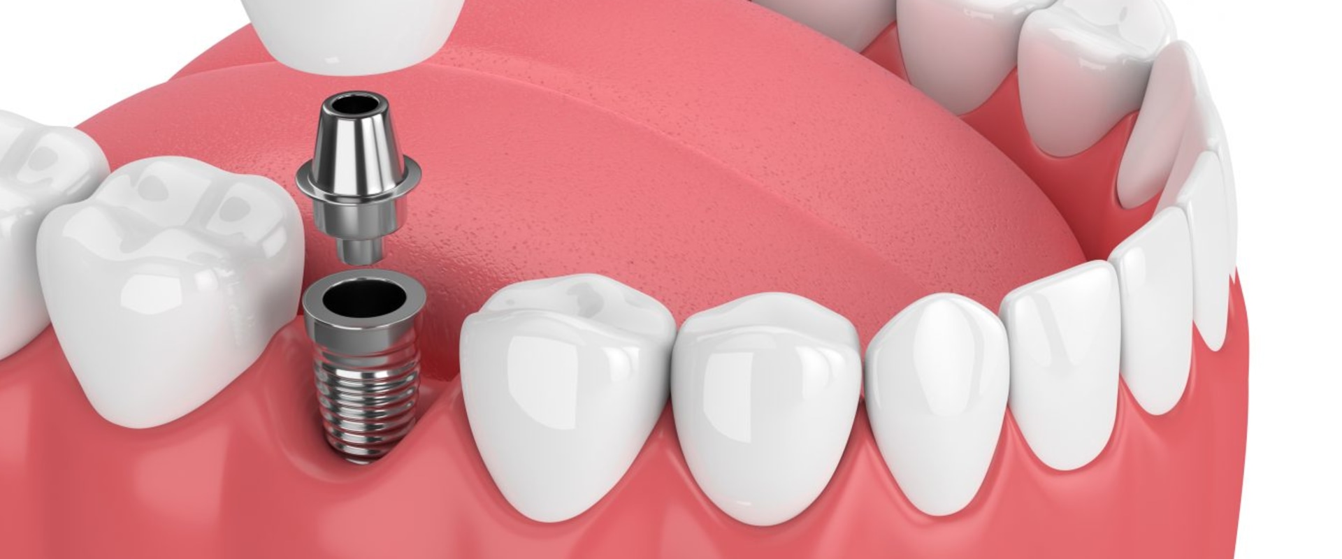 How long does a dental implant last?