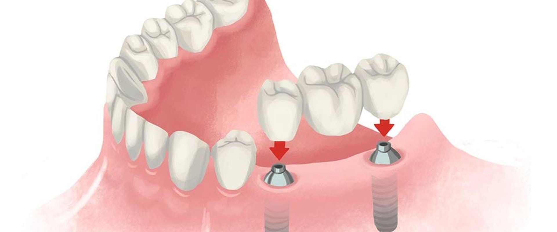 Are dental implants expensive?