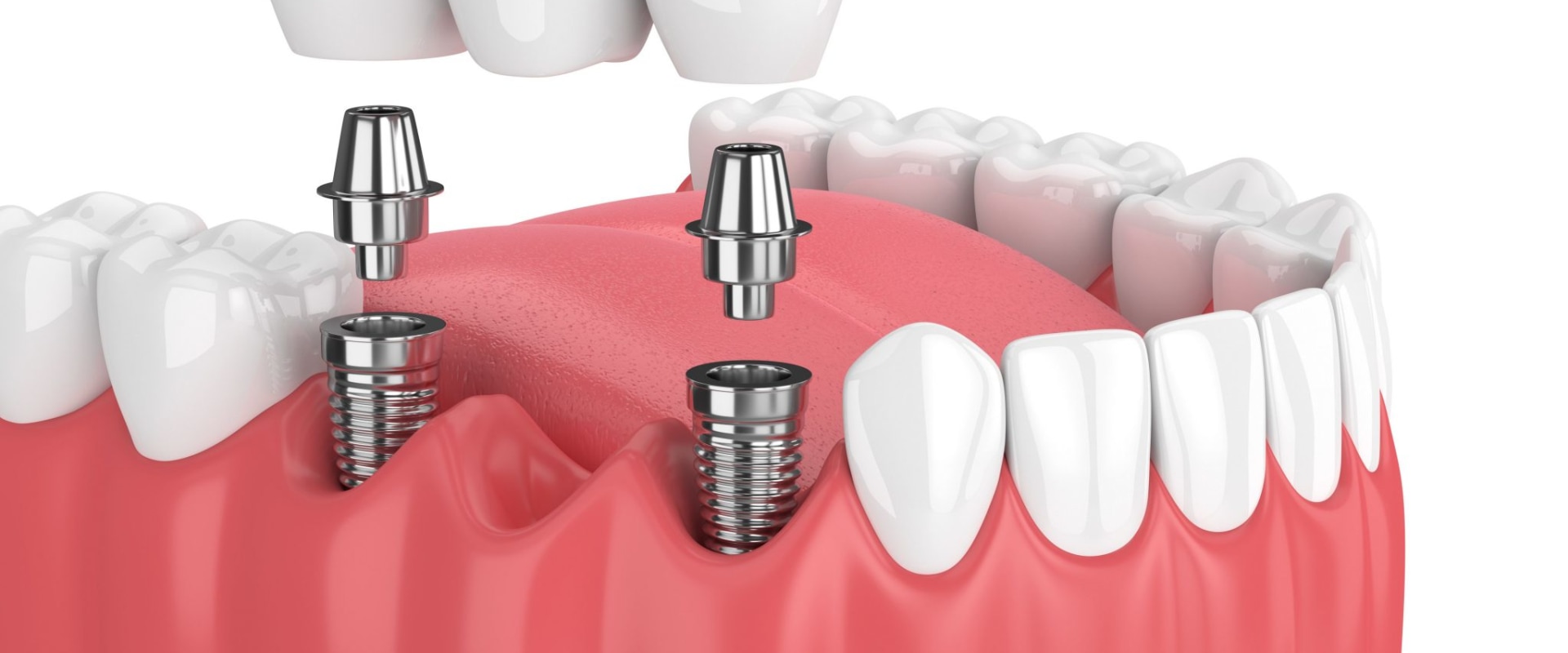 How are dental implants done step by step?