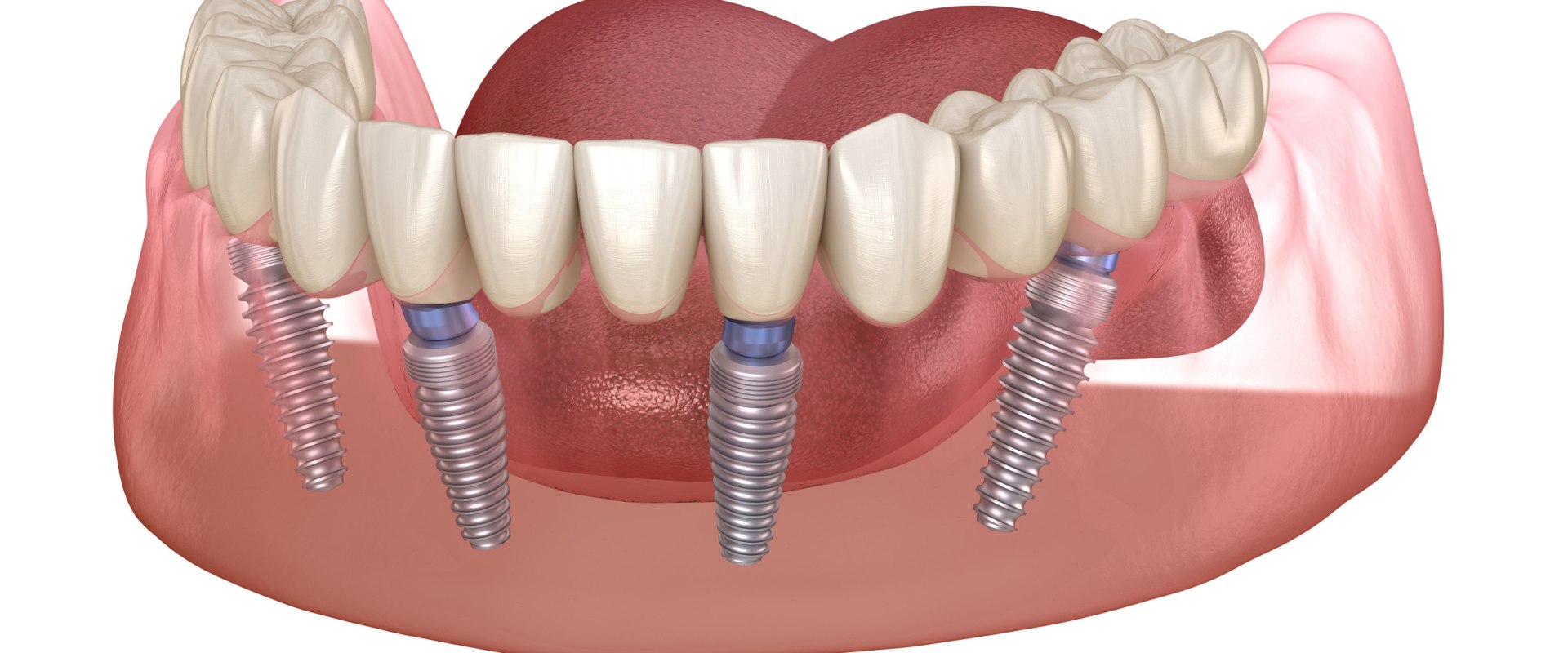 Why are full mouth implants so expensive?