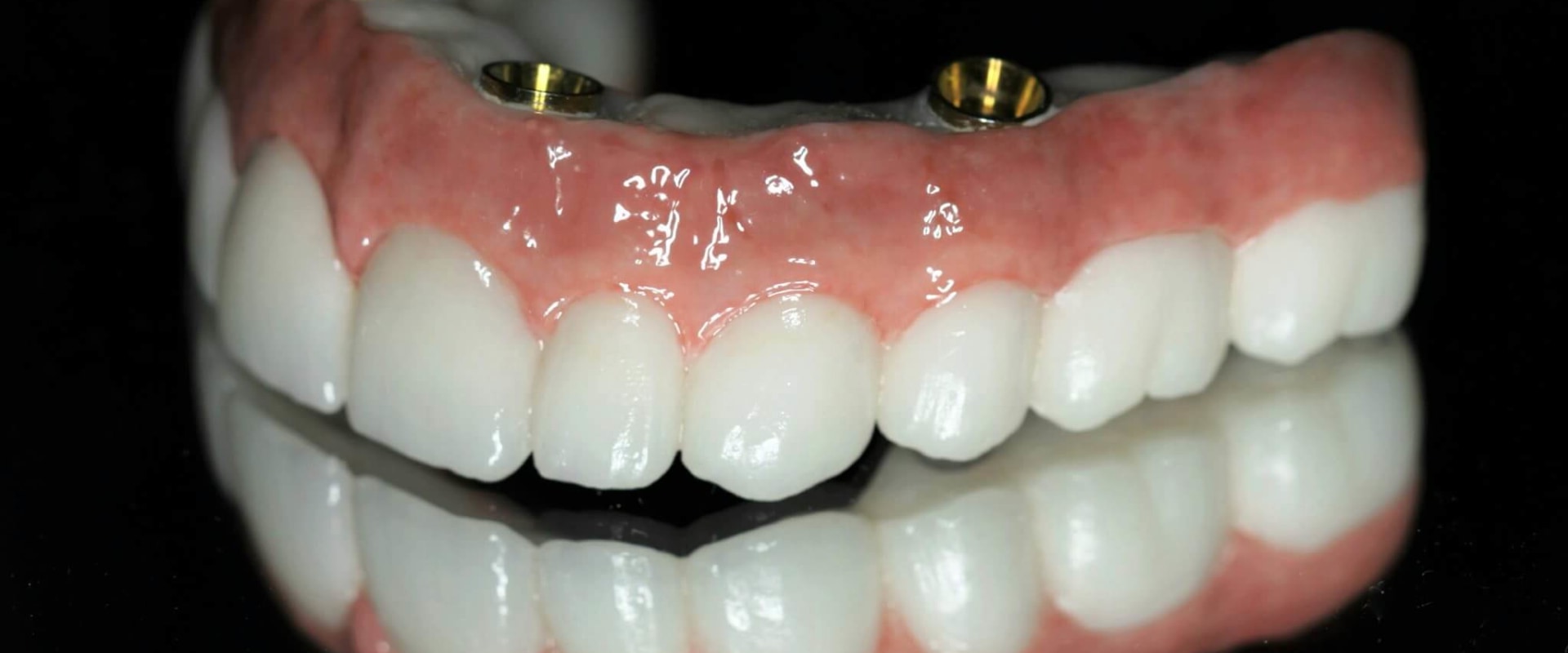 Which is a leading cause of dental implant failure?