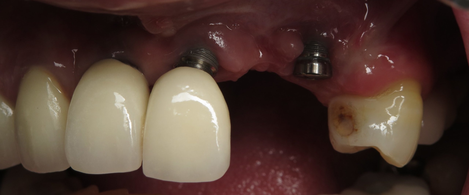 When dental implants fail?
