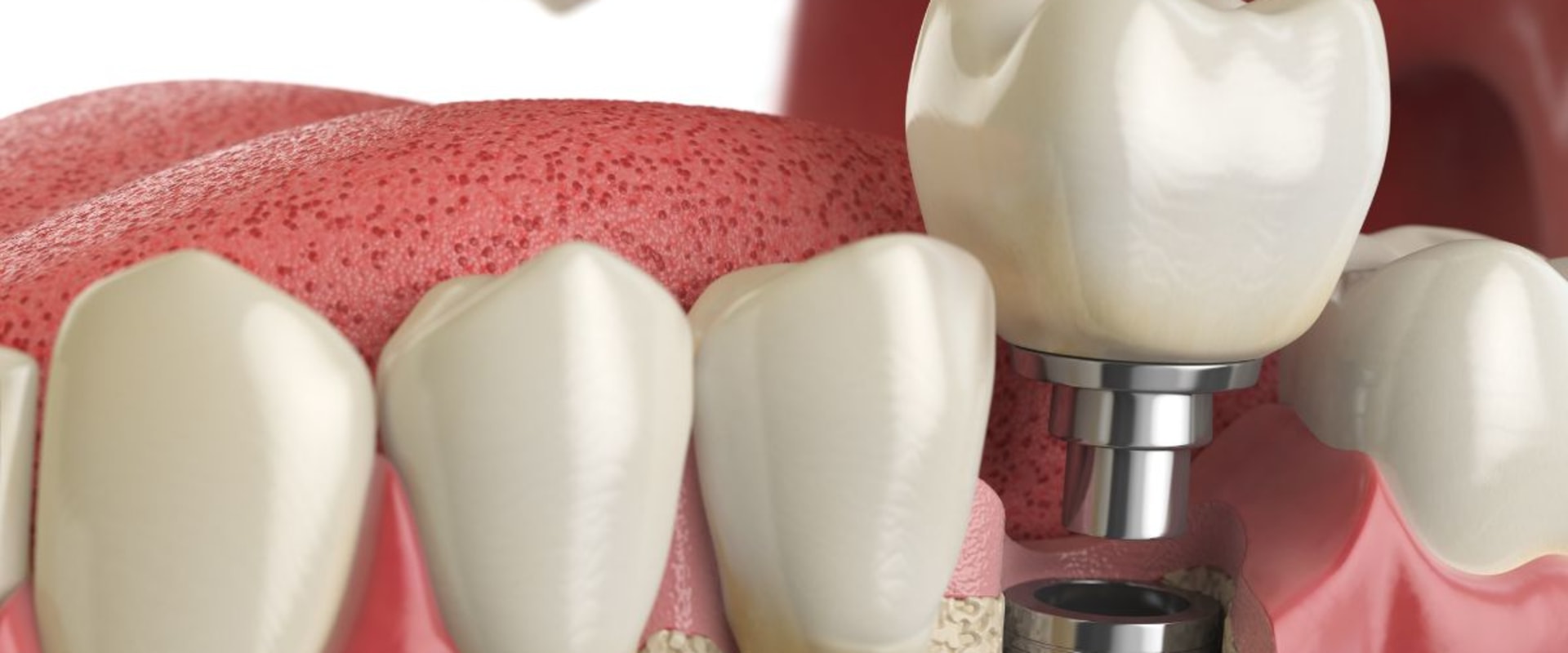 Preparing for Your Dental Implants Consultation