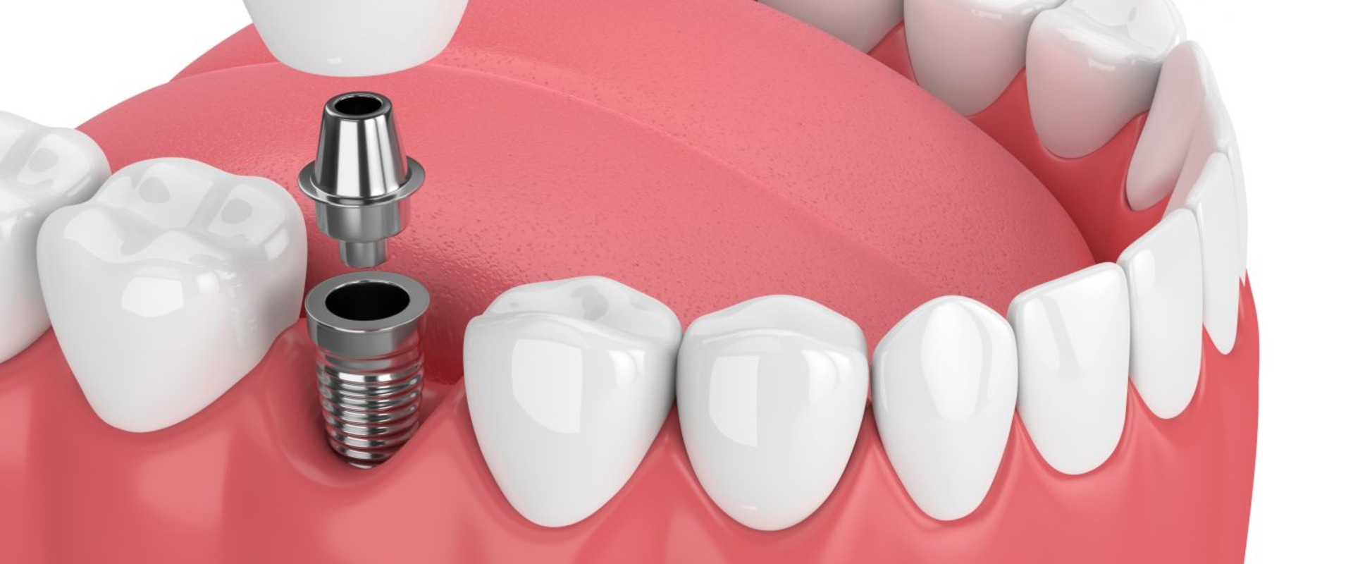 Can dental implants make you sick?