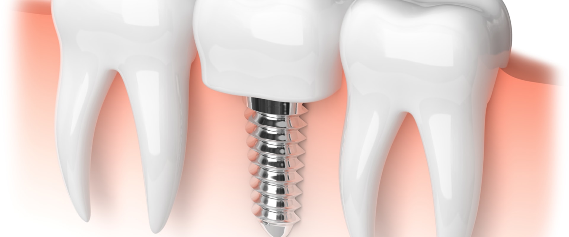 How dental implants work?