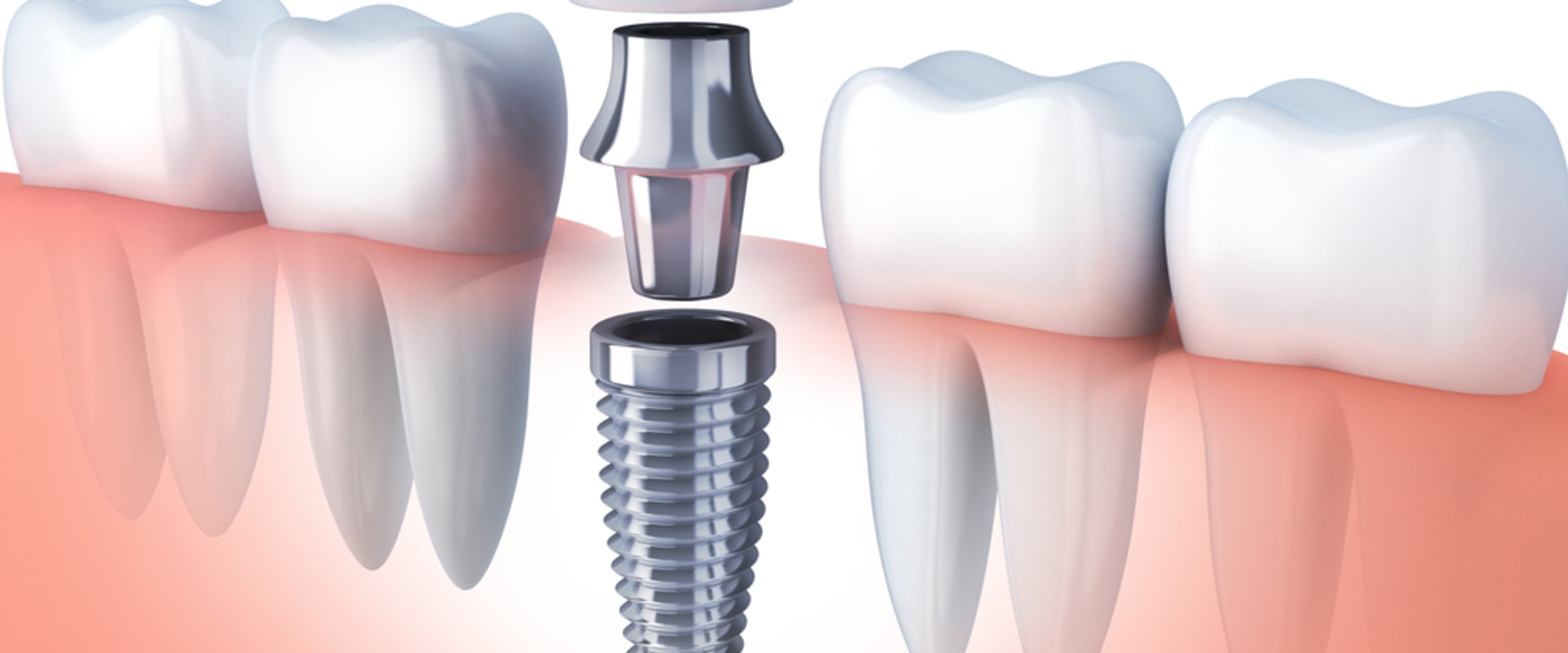 What You Need To Know About Dental Implants In Borger