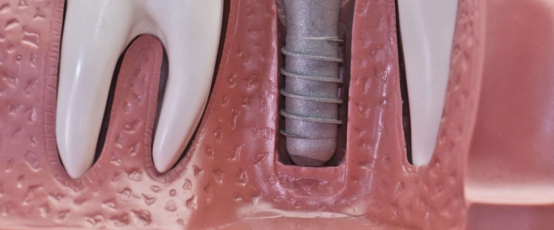 How long does it take for dental implants to stop hurting?
