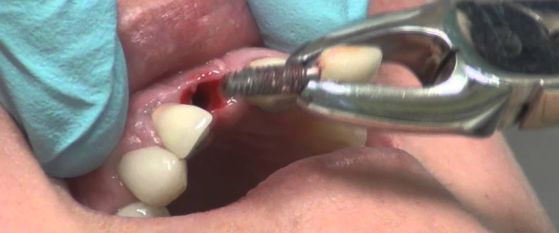 Can dental implants be removed?