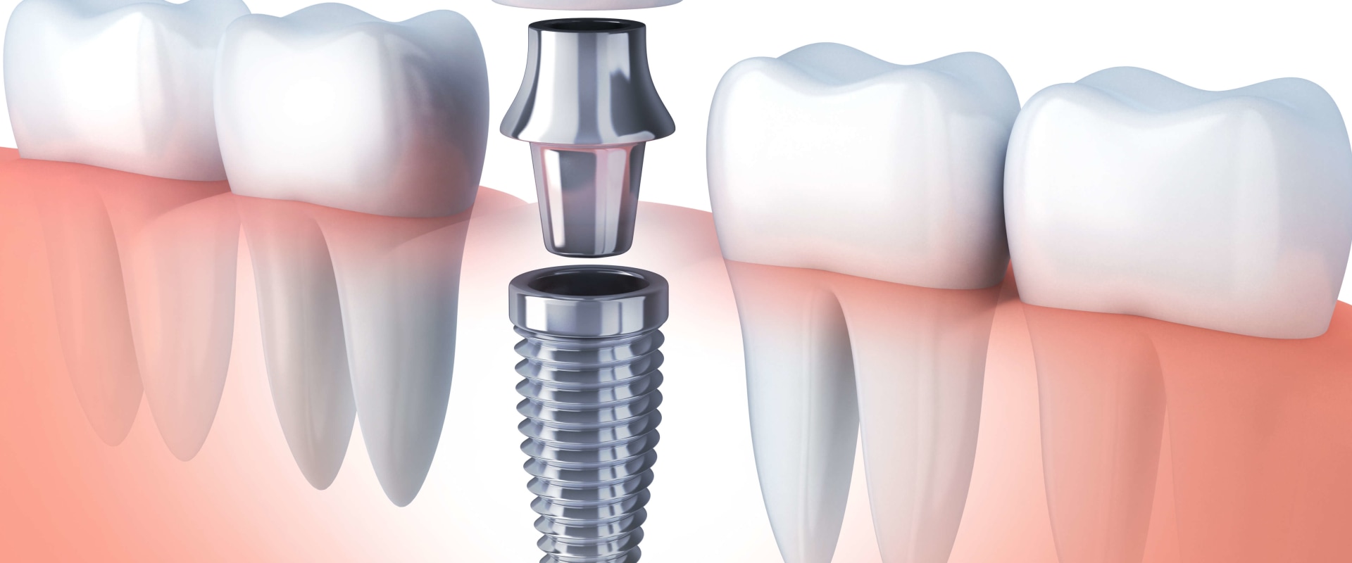 Why Now Is The Perfect Time To Consider Dental Implants In Mission Viejo