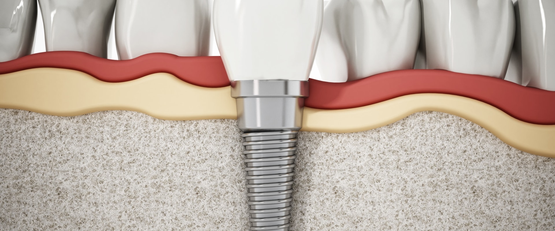 Discover The Benefits Of Dental Implants In Georgetown: Everything You Need To Know