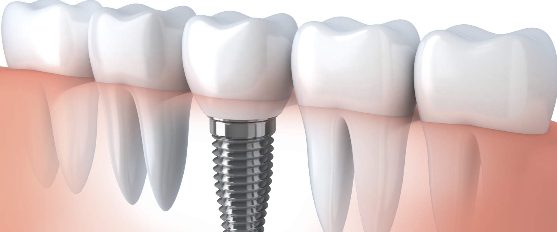 How dental implants are made?