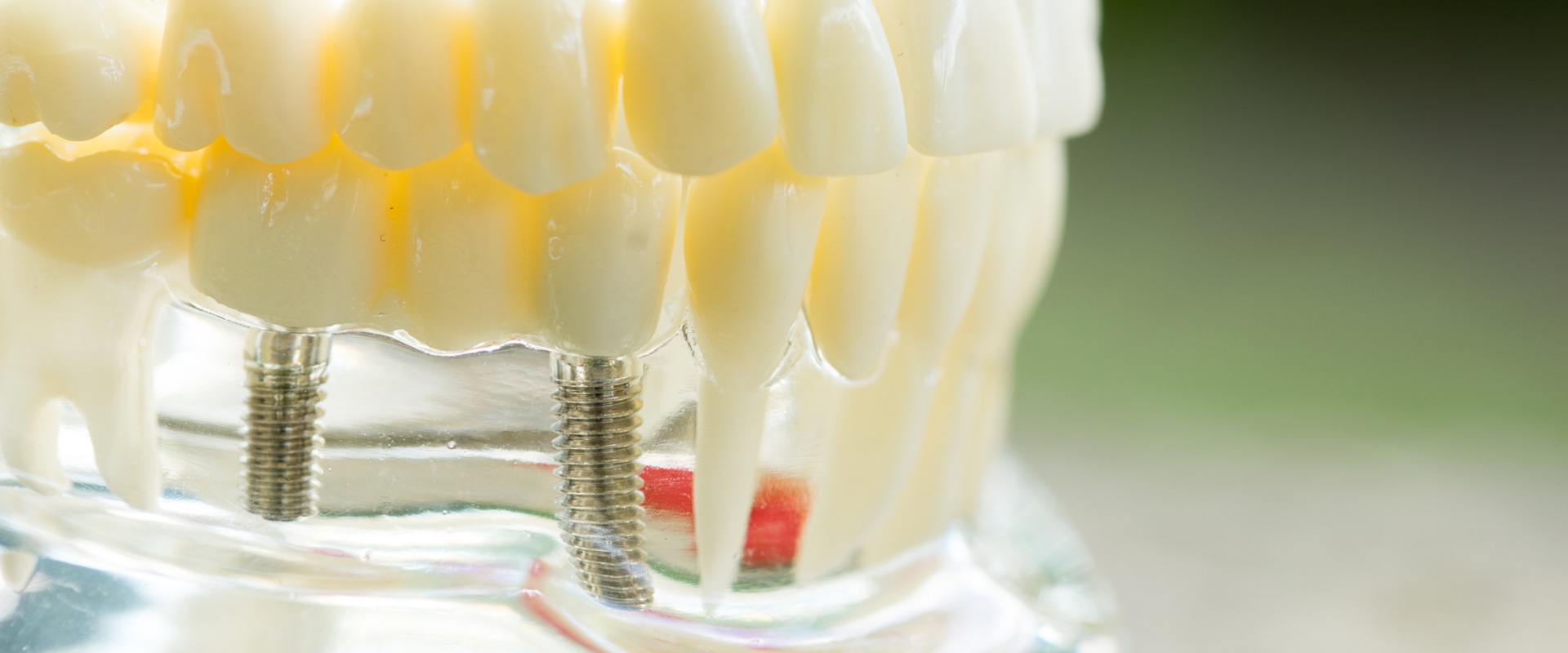 The Process For Getting Dental Implants In McGregor