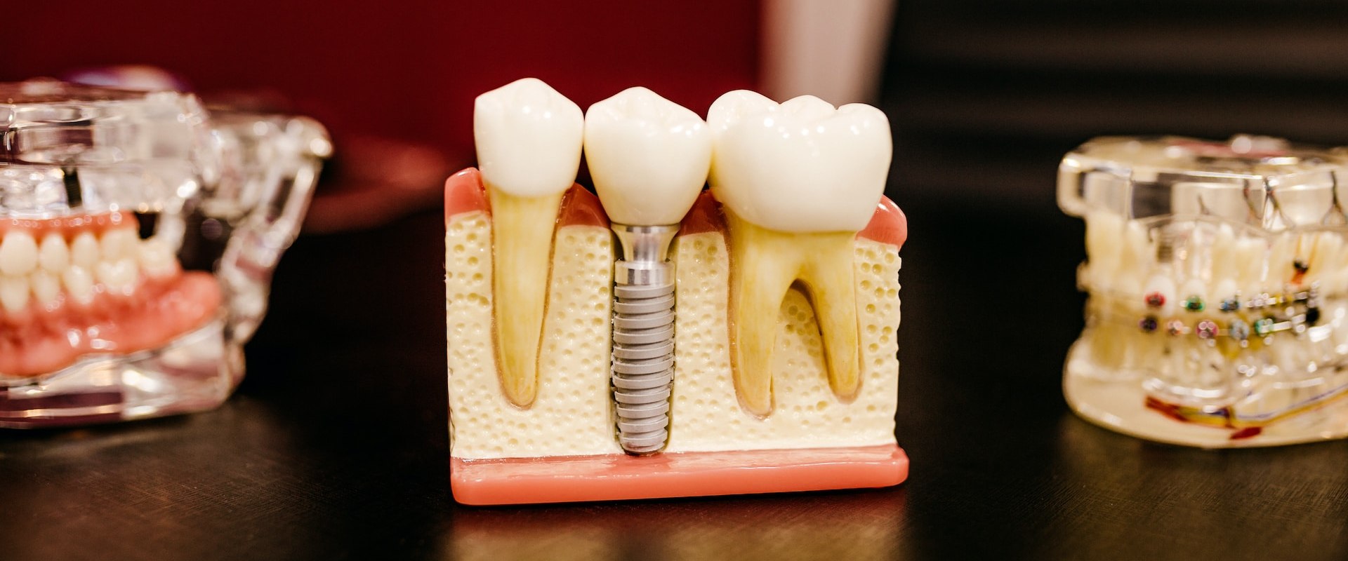 Benefits Of Aftercare For Dental Implants: A Guide From The Best Dentist In Kota Kinabalu