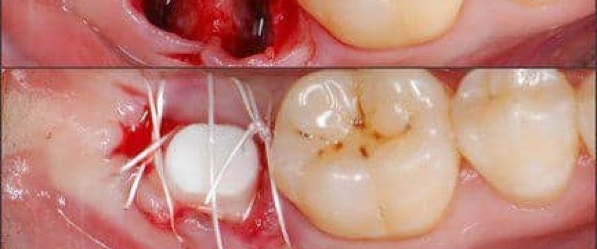 Do dental implants hurt?
