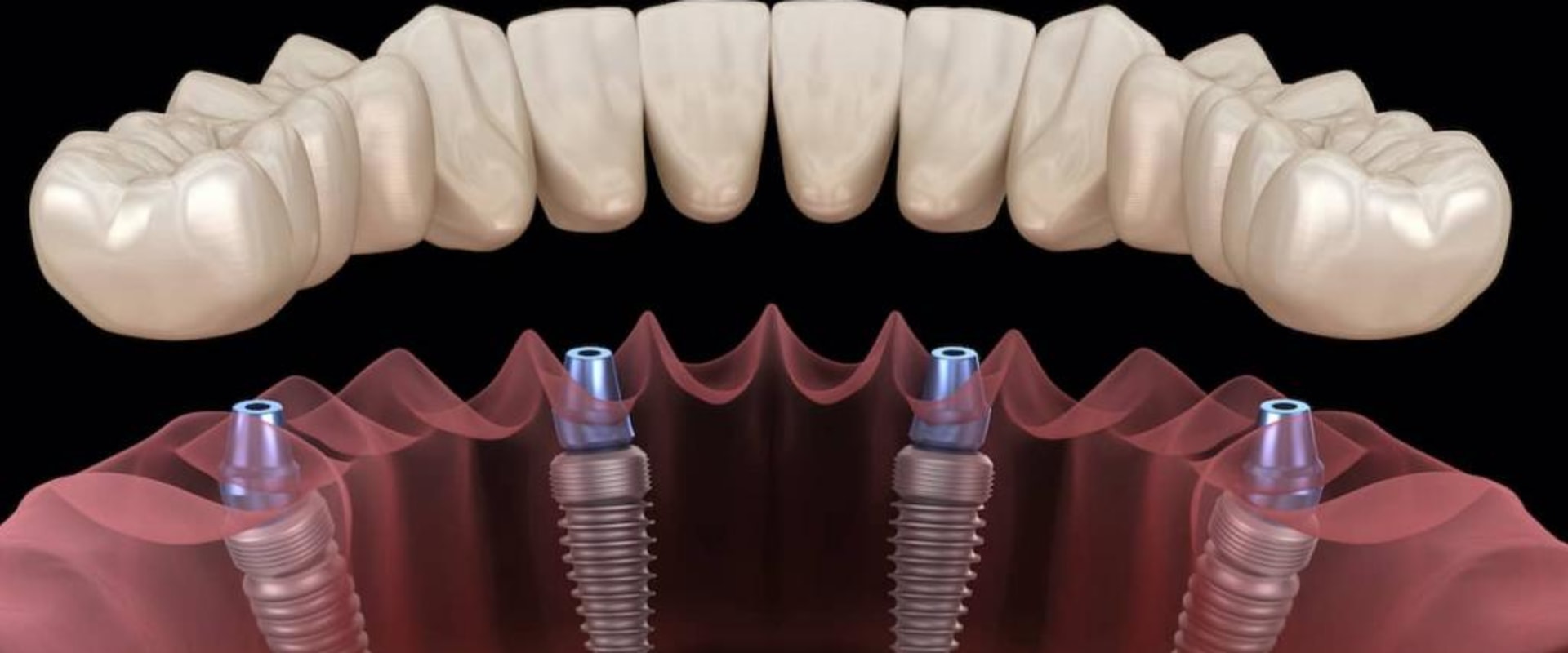 What is the best implant for teeth?