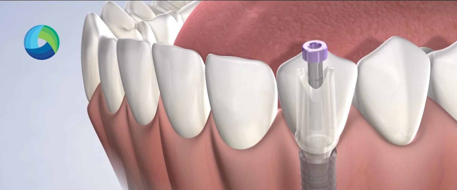 What You Need To Know Before Getting Dental Implants In New Jersey