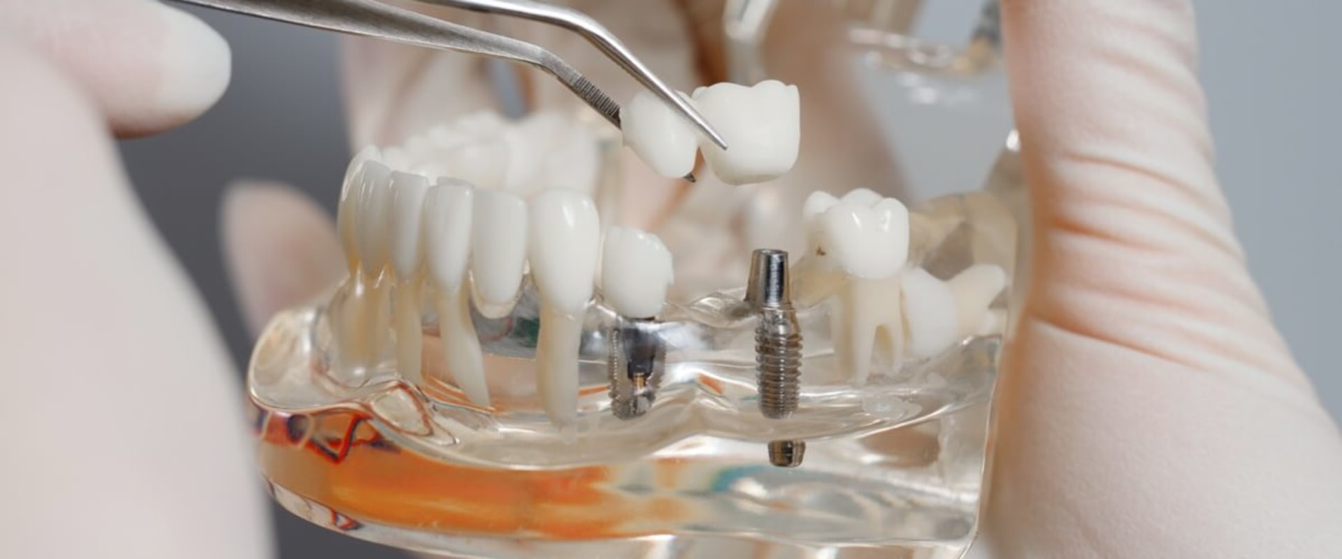 Will dental implants get cheaper?