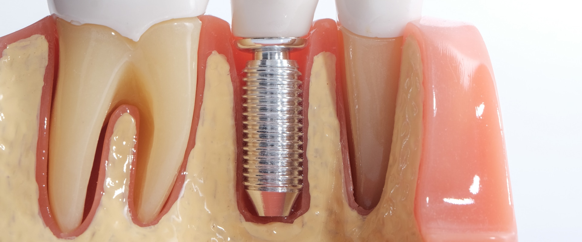 All You Need To Know About Getting Dental Implants In Cedar Park