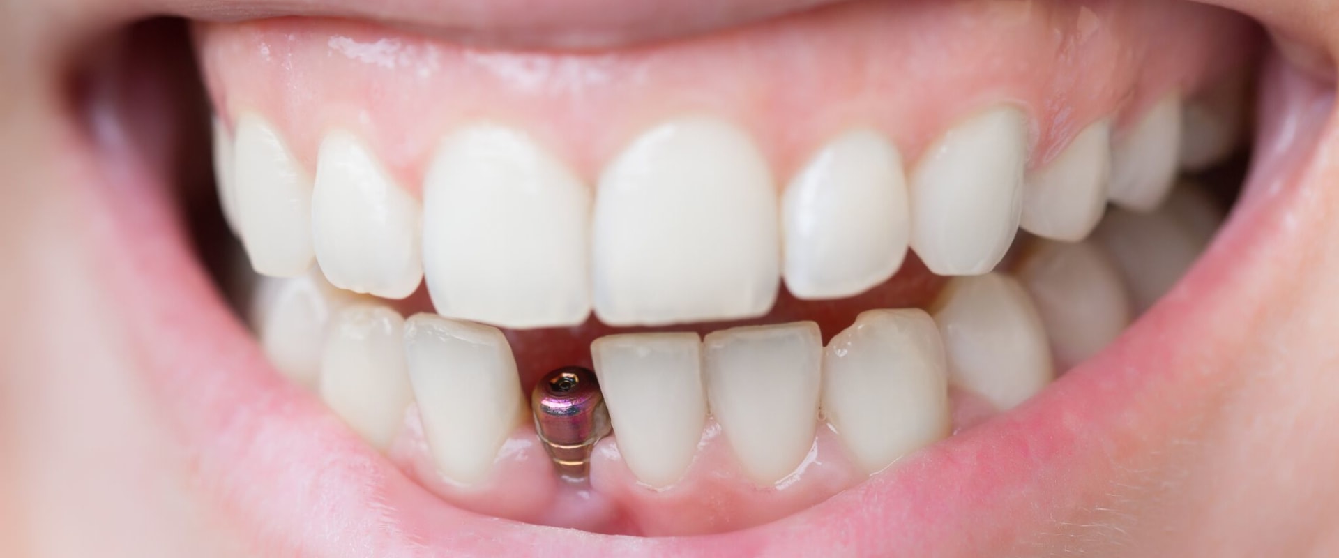 Where does the bone come from for dental implants?