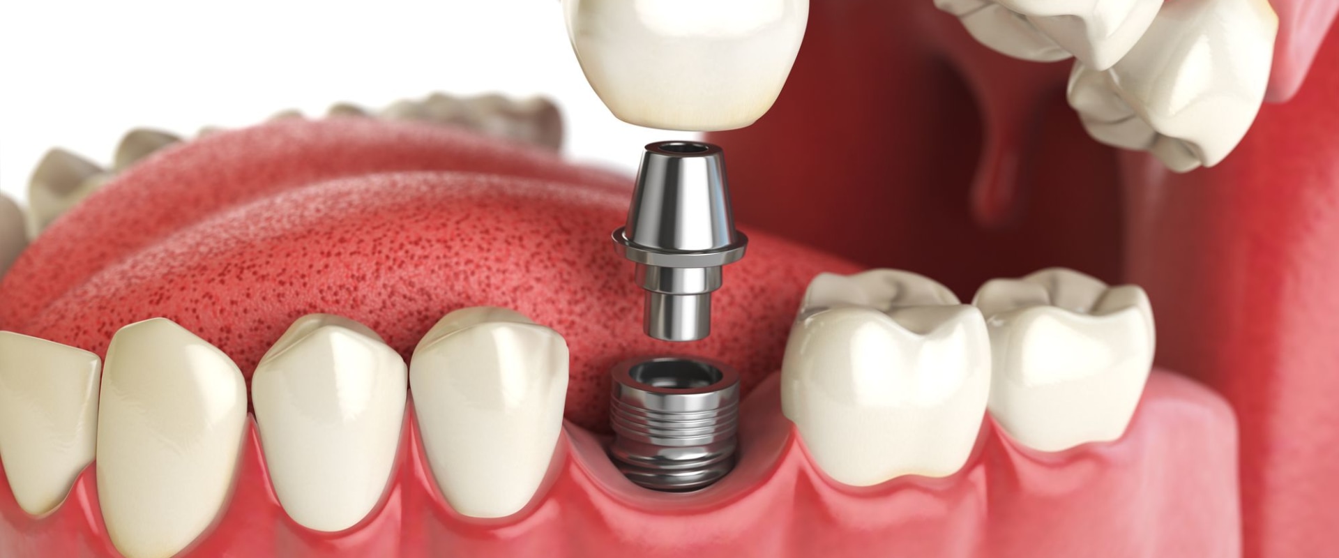 Which dental implants last the longest?