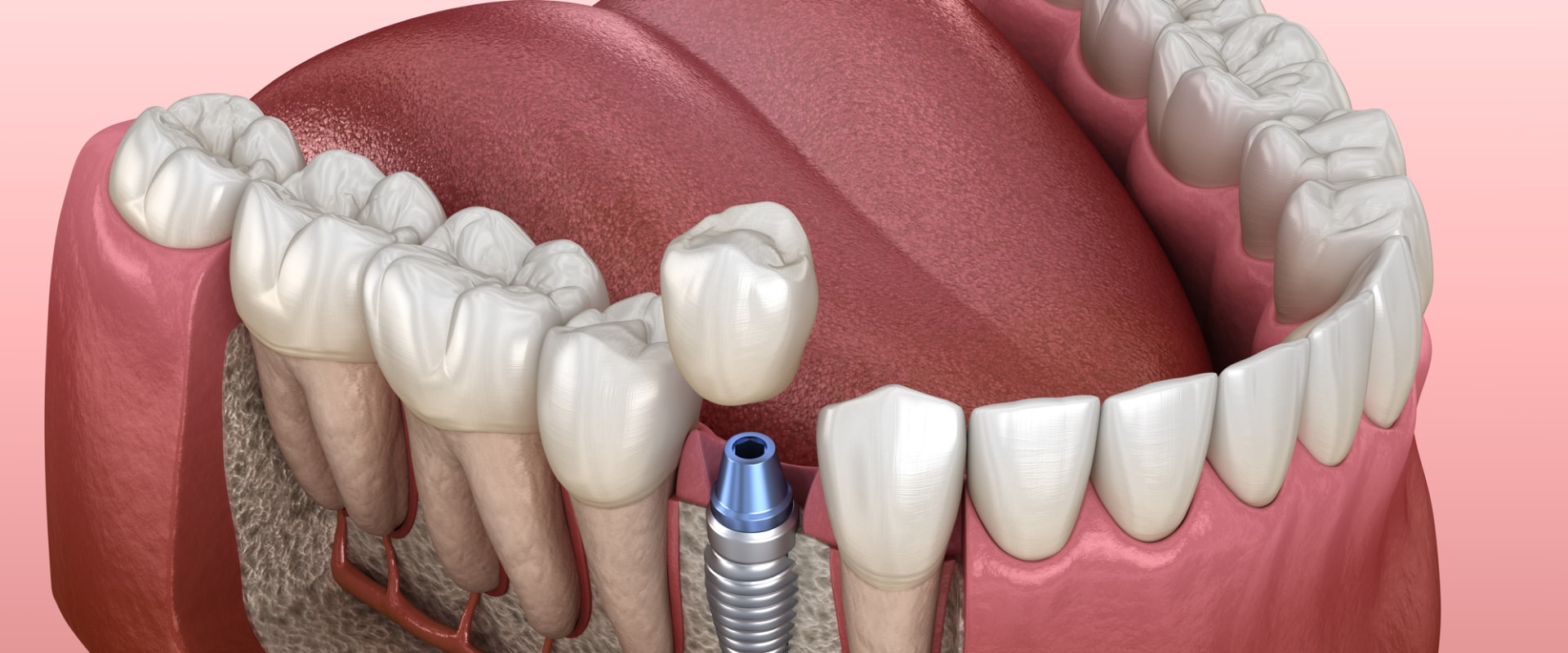Why Are Dental Implants The Most Effective Treatment In Boerne For Tooth Loss And Damage