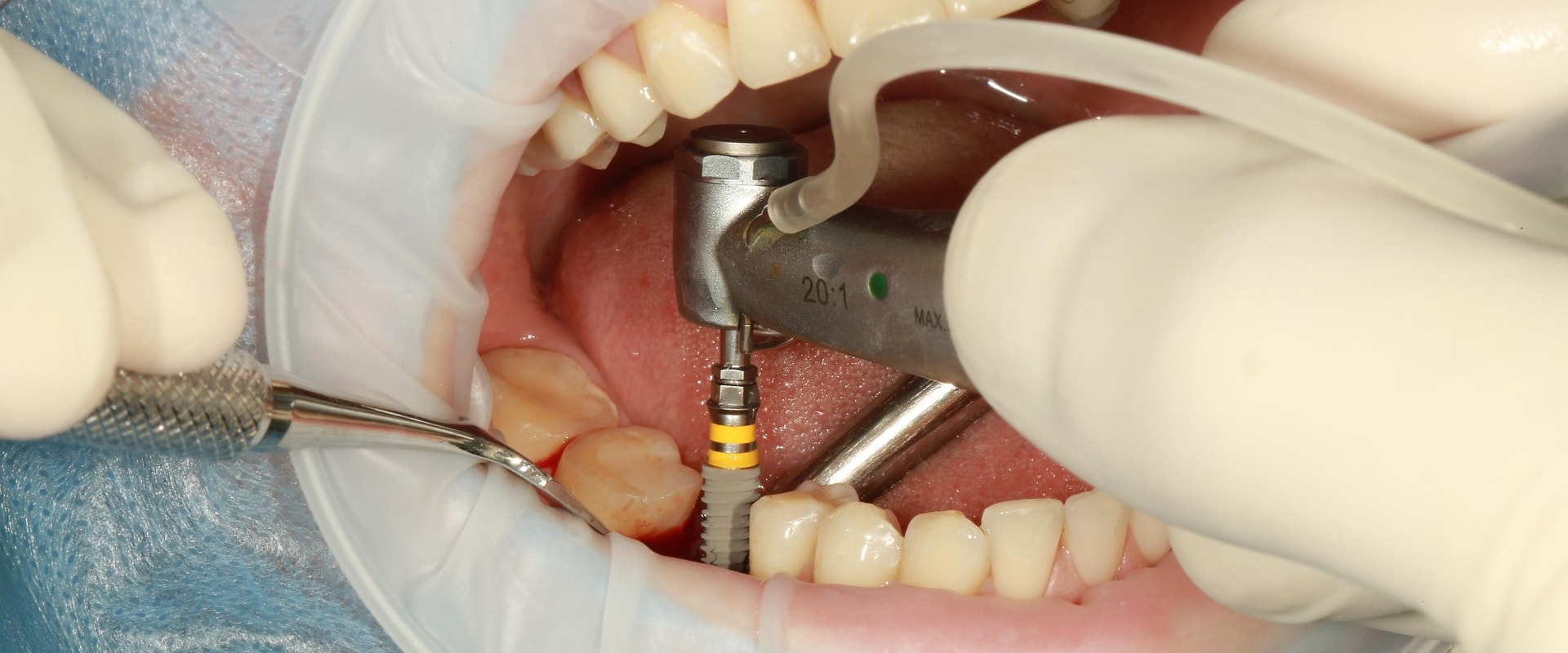 Dental Implants in Switzerland: Modern Solutions for Lasting Smiles