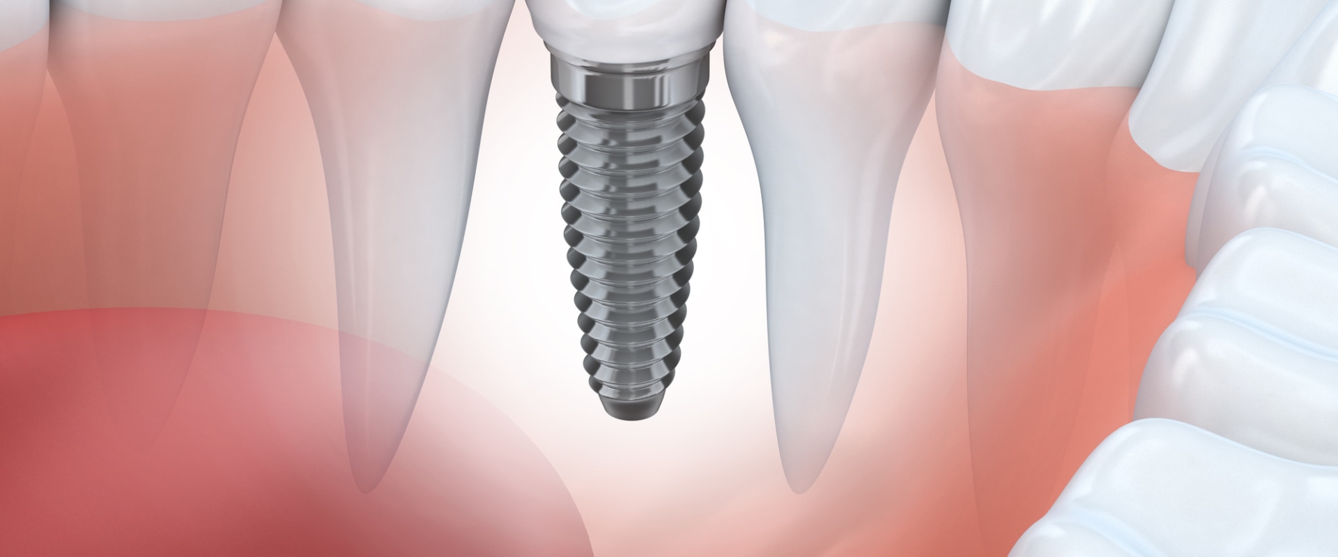 Choosing The Right Dentist For Dental Implants In Rockville, MD