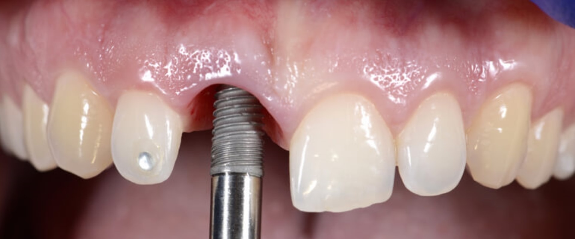 Discovering The Benefits Of Dental Implants In Austin