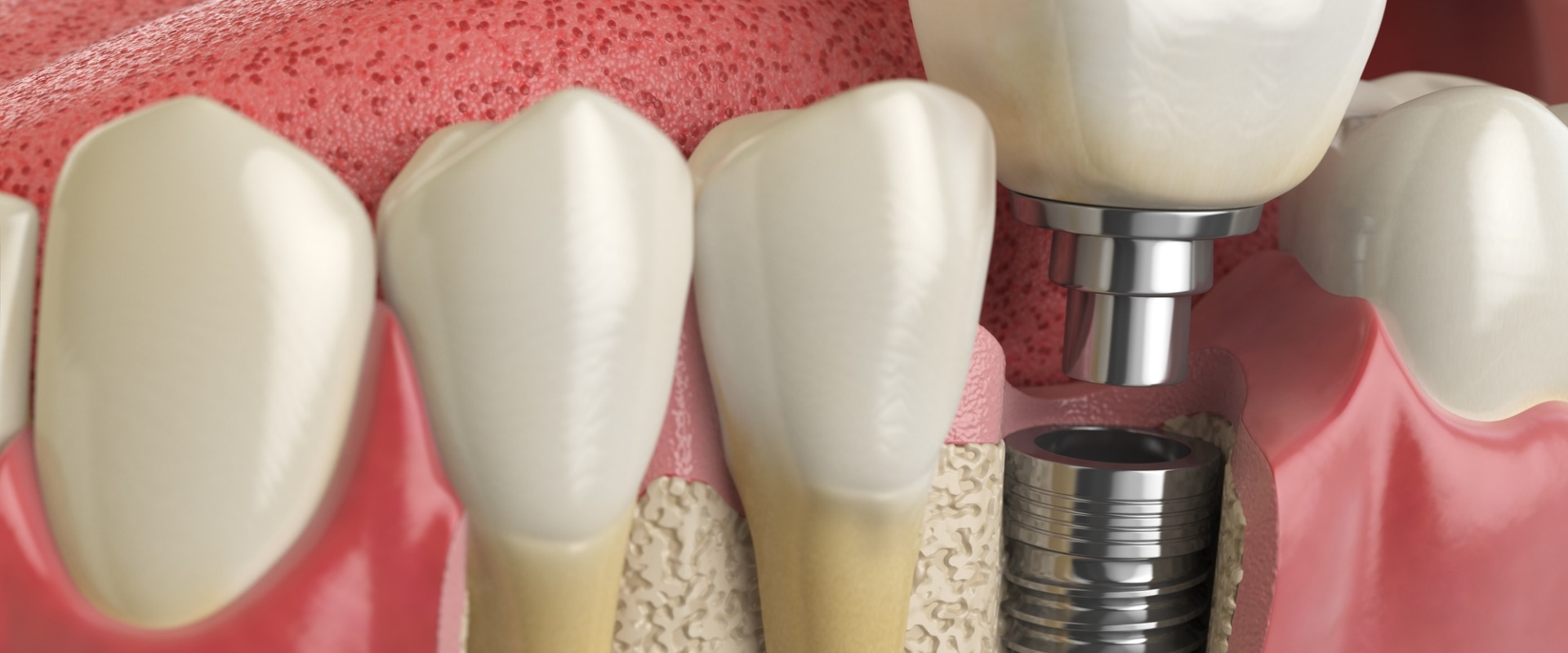 What To Expect When Getting Dental Implants In Ellsworth