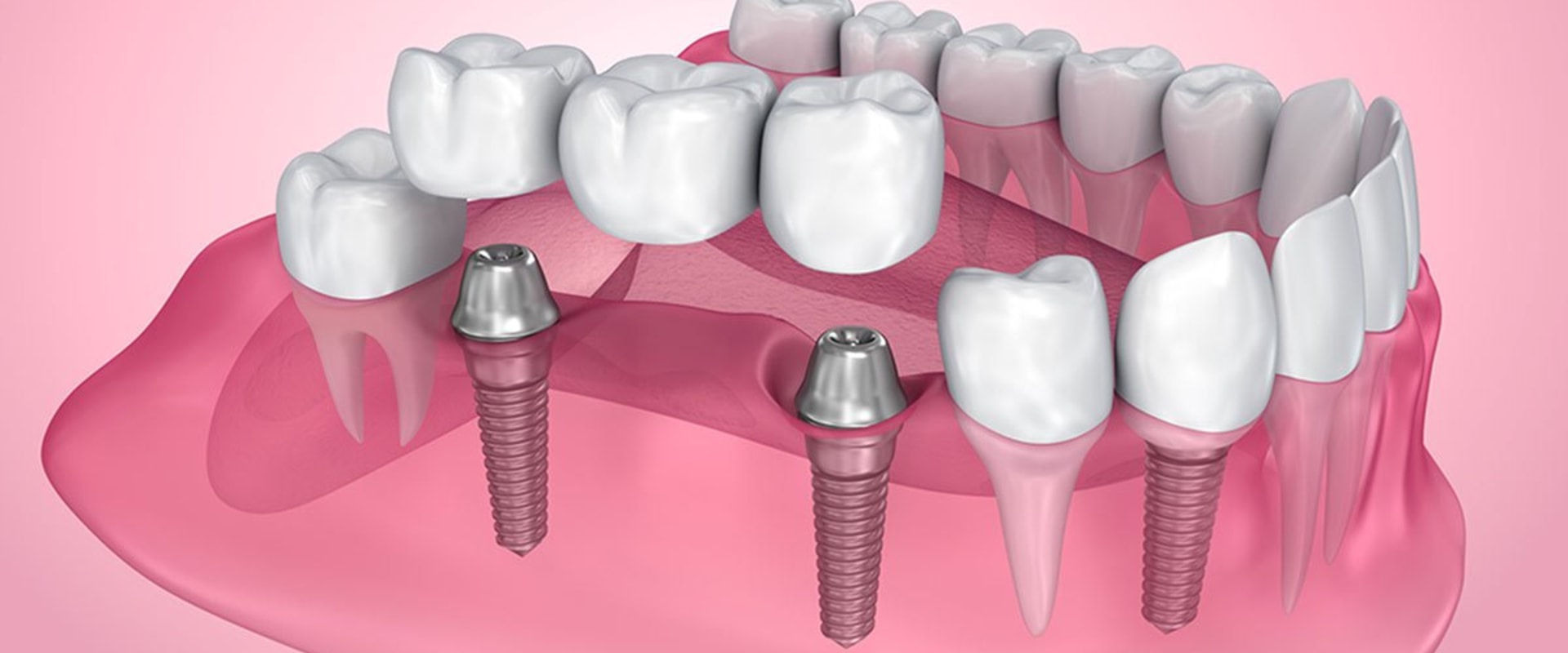 Why dental implants are important?