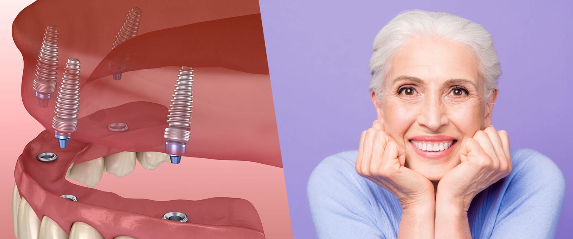 The Definitive Guide To Dental Implants In Spring, TX: All You Need To Know As A Patient