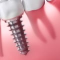 Can dental implants cause health issues?