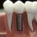 Are dental implants permanent?