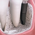 Are dental implants covered by insurance?