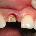 How long does a dental implant take from start to finish?