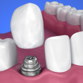 What is the most common cause of implant failure?