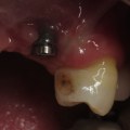 Can dental implants fall out?