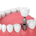 Modern Dental Implants Explained By A Professional Dentist In Taylor, Texas