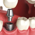 Which dentist do implants?