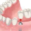 Are dental implants expensive?