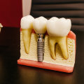 Say Goodbye To Gaps: How Dental Implants In Edmonds, WA Can Transform Your Smile