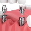 How are dental implants done step by step?